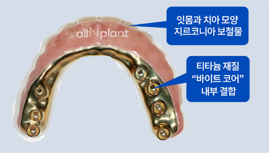 잇몸과 치아 모양 지르코니아 보철물 / 티타늄 재질 “바이트 코어” 내부 결합