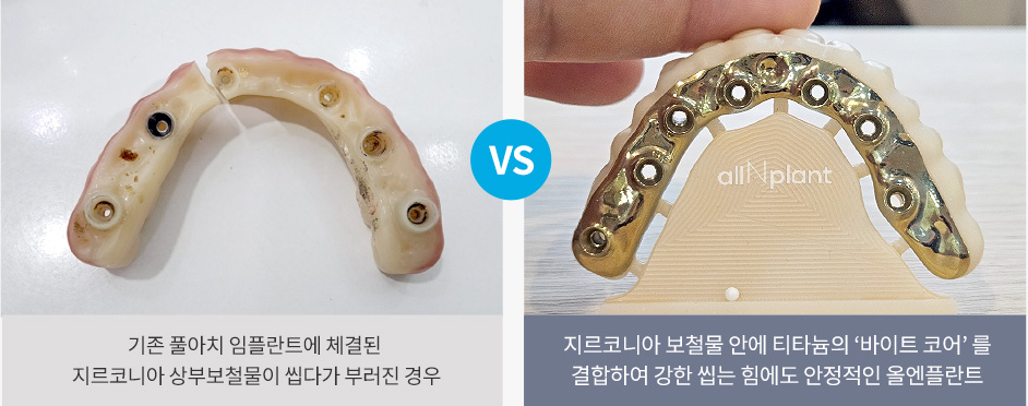 기존 풀아치 임플란트에 체결된 지르코니아 상부보철물이 씹다가 부러진 경우 VS 지르코니아 보철물 안에 티타늄의 ‘바이트 코어’ 를 결합하여 강한 씹는 힘에도 안정적인 올엔플란트