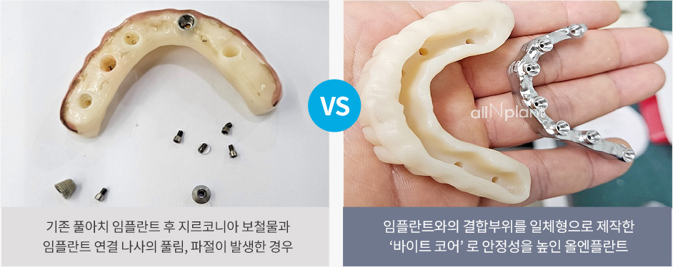 기존 풀아치 임플란트 후 지르코니아 보철물과 임플란트 연결 나사의 풀림, 파절이 발생한 경우 VS 임플란트와의 결합부위를 일체형으로 제작한 ‘바이트 코어’ 로 안정성을 높인 올엔플란트