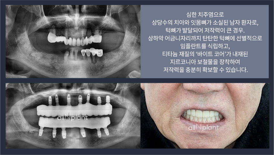 심한 치주염으로 상당수의 치아와 잇몸뼈가 소실된 남자 환자로, 턱뼈가 발달되어 저작력이 큰 경우. 상하악 어금니자리까지 탄탄한 턱뼈에 선별적으로 임플란트를 식립하고, 티타늄 재질의 ‘바이트 코어’가 내재된 지르코니아 보철물을 장착하여 저작력을 충분히 확보할 수 있습니다.