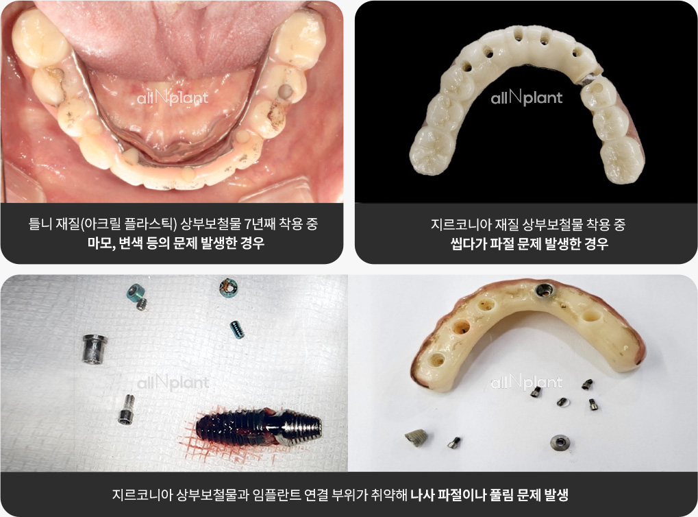 틀니 재질(아크릴 플라스틱) 상부보철물 7년째 착용 중 마모, 변색 등의 문제 발생한 경우 / 지르코니아 재질 상부보철물 착용 중 씹다가 파절 문제 발생한 경우 / 지르코니아 상부보철물과 임플란트 연결 부위가 취약해 나사 파절이나 풀림 문제 발생