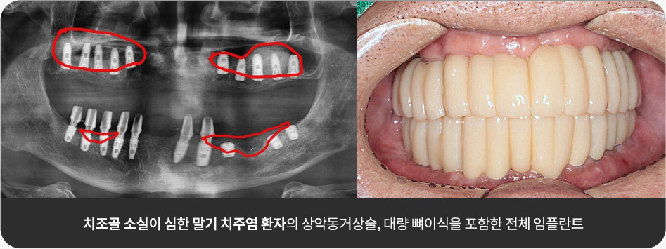 치조골 소실이 심한 말기 치주염 환자의 상악동거상술, 대량 뼈이식을 포함한 전체 임플란트