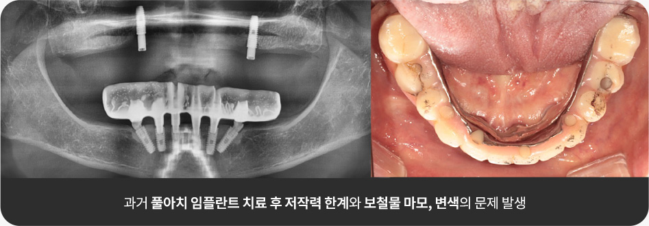 과거 풀아치 임플란트 치료 후 저작력 한계와 보철물 마모, 변색의 문제 발생
