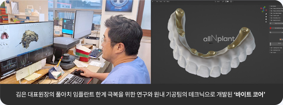 김은 대표원장의 풀아치 임플란트 한계 극복을 위한 연구와 원내 기공팀의 테크닉으로 개발된 ‘바이트 코어’