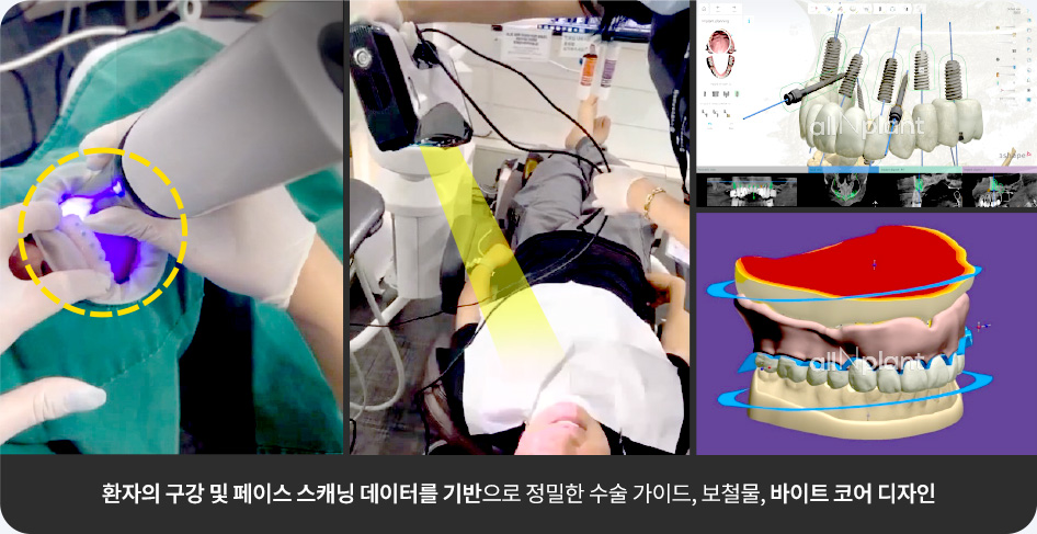 환자의 구강 및 페이스 스캐닝 데이터를 기반으로 정밀한 수술 가이드, 보철물, 바이트 코어 디자인