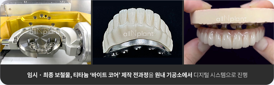 임시 · 최종 보철물, 티타늄 ‘바이트 코어’ 제작 전과정을 원내 기공소에서 디지털 시스템으로 진행