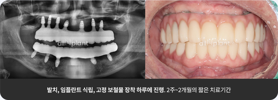 발치, 임플란트 식립, 고정 보철물 장착 하루에 진행. 2주~2개월의 짧은 치료기간
