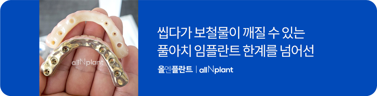 씹다가 보철물이 깨질 수 있는 풀아치 임플란트 한계를 넘어선