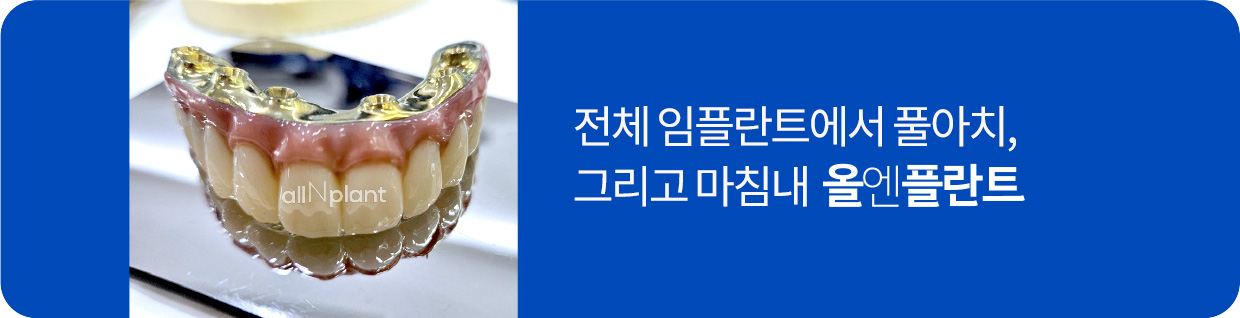 전체 임플란트에서 풀아치, 그리고 마침내 올엔플란트