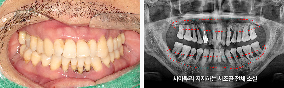 치아뿌리 지지하는 치조골 전체 소실