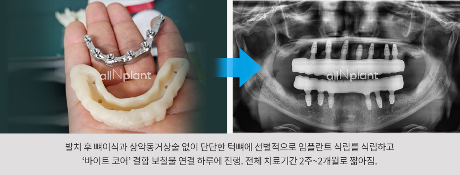 발치 후 뼈이식과 상악동거상술 없이 단단한 턱뼈에 선별적으로 임플란트 식립를 식립하고 ‘바이트 코어’ 결합 보철물 연결 하루에 진행. 전체 치료기간 2주~2개월로 짧아짐.