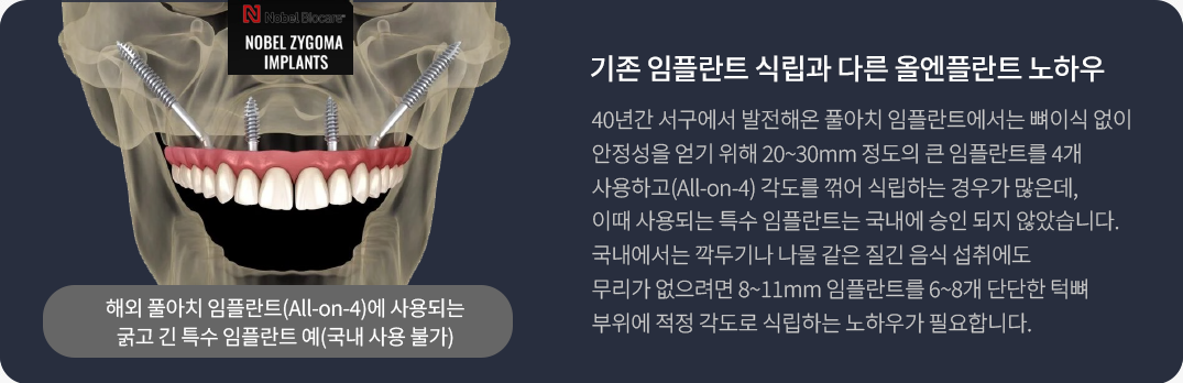 기존 임플란트 식립과 다른 올엔플란트 노하우. 40년간 서구에서 발전해온 풀아치 임플란트에서는 뼈이식 없이 안정성을 얻기 위해 20~30mm 정도의 큰 임플란트를 4개 사용하고(All-on-4) 각도를 꺾어 식립하는 경우가 많은데, 이때 사용되는 특수 임플란트는 국내에 승인 되지 않았습니다. 국내에서는 깍두기나 나물 같은 질긴 음식 섭취에도 무리가 없으려면 8~11mm 임플란트를 6~8개 단단한 턱뼈 부위에 적정 각도로 식립하는 노하우가 필요합니다.