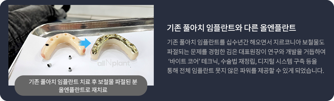 기존 풀아치 임플란트와 다른 올엔플란트. 기존 풀아치 임플란트를 십수년간 해오면서 지르코니아 보철물도 파절되는 문제를 경험한 김은 대표원장이 연구와 개발을 거듭하여 ‘바이트 코어’ 테크닉, 수술법 재정립, 디지털 시스템 구축 등을 통해 전체 임플란트 못지 않은 파워를 제공할 수 있게 되었습니다.