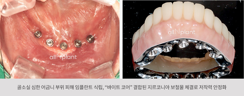 골소실 심한 어금니 부위 피해 임플란트 식립, “바이트 코어” 결합된 지르코니아 보철물 체결로 저작력 안정화