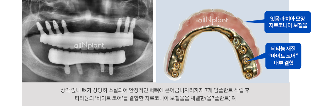 잇몸과 치아 모양 지르코니아 보철물 / 티타늄 재질 “바이트 코어” 내부 결합. 상악 앞니 뼈가 상당히 소실되어 안정적인 턱뼈에 큰어금니자리까지 7개 임플란트 식립 후 티타늄의 ‘바이트 코어’를 결합한 지르코니아 보철물을 체결한(올7플란트) 예