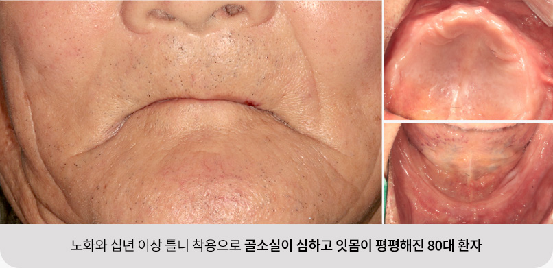 노화와 십년 이상 틀니 착용으로 골소실이 심하고 잇몸이 평평해진 80대 환자