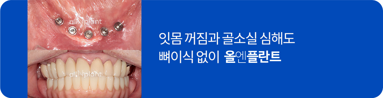 잇몸 꺼짐과 골소실 심해도 뼈이식 없이 올엔플란트