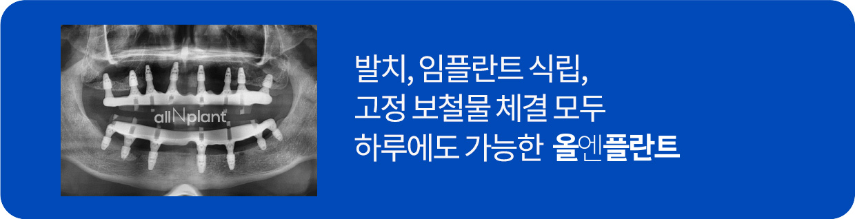 발치, 임플란트 식립, 고정 보철물 체결 모두 하루에도 가능한 올엔플란트