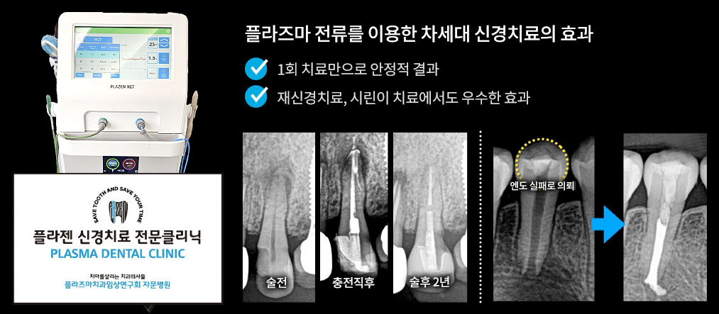 플라즈마 전류를 이용한 차세대 신경치료의 효과 - 1회 치료만으로 안정적 결과 / 재신경치료, 시린이 치료에서도 우수한 효과