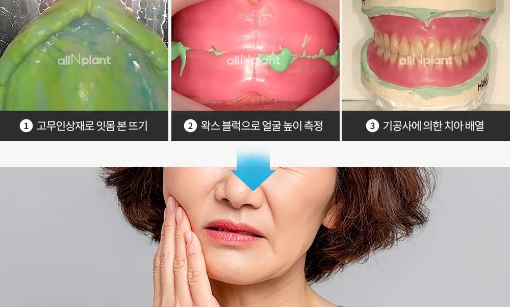 1. 고무인상재로 잇몸 본 뜨기 | 2. 왁스 블럭으로 얼굴 높이 측정 | 3. 기공사에 의한 치아 배열