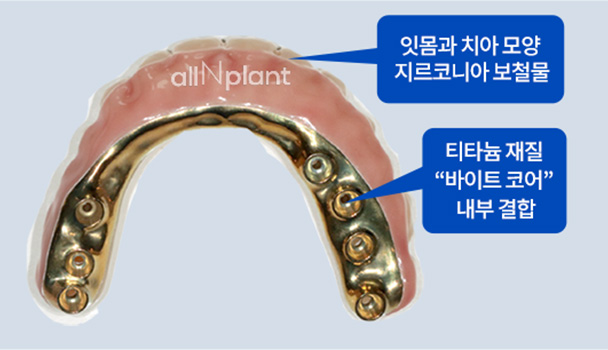 잇몸과 치아 모양 지르코니아 보철물 / 티타늄 재질 “바이트 코어” 내부 결합
