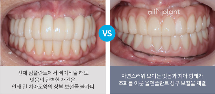 전체 임플란트에서 뼈이식을 해도 잇몸의 완벽한 재건은 안돼 긴 치아모양의 상부 보철물 불가피 VS 자연스러워 보이는 잇몸과 치아 형태가 조화를 이룬 올엔플란트 상부 보철물 체결