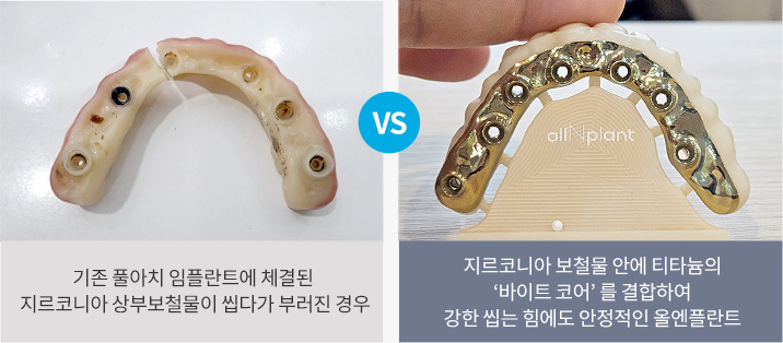 기존 풀아치 임플란트에 체결된 지르코니아 상부보철물이 씹다가 부러진 경우 VS 지르코니아 보철물 안에 티타늄의 ‘바이트 코어’ 를 결합하여 강한 씹는 힘에도 안정적인 올엔플란트