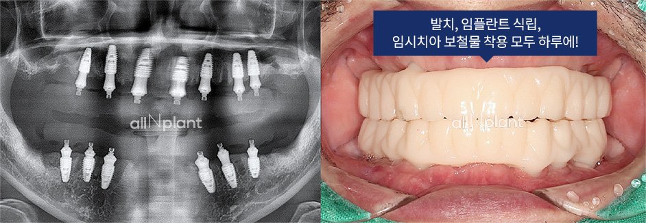 발치, 임플란트 식립, 임시치아 보철물 착용 모두 하루에!