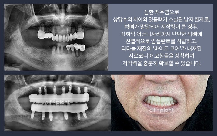 심한 치주염으로 상당수의 치아와 잇몸뼈가 소실된 남자 환자로, 턱뼈가 발달되어 저작력이 큰 경우. 상하악 어금니자리까지 탄탄한 턱뼈에 선별적으로 임플란트를 식립하고, 티타늄 재질의 ‘바이트 코어’가 내재된 지르코니아 보철물을 장착하여 저작력을 충분히 확보할 수 있습니다.