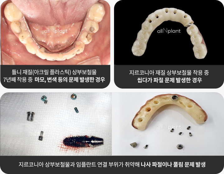 틀니 재질(아크릴 플라스틱) 상부보철물 7년째 착용 중 마모, 변색 등의 문제 발생한 경우 / 지르코니아 재질 상부보철물 착용 중 씹다가 파절 문제 발생한 경우 / 지르코니아 상부보철물과 임플란트 연결 부위가 취약해 나사 파절이나 풀림 문제 발생