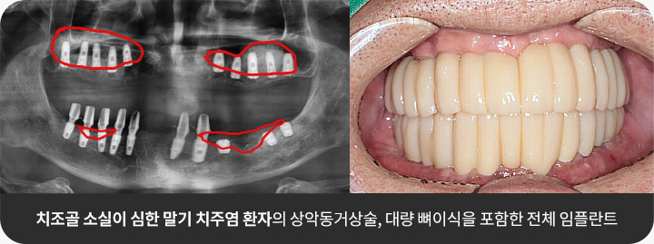 치조골 소실이 심한 말기 치주염 환자의 상악동거상술, 대량 뼈이식을 포함한 전체 임플란트