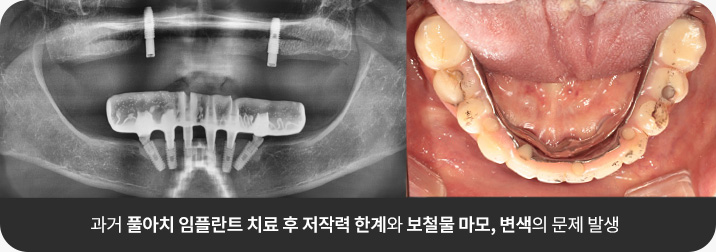 과거 풀아치 임플란트 치료 후 저작력 한계와 보철물 마모, 변색의 문제 발생
