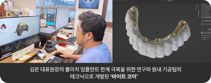 김은 대표원장의 풀아치 임플란트 한계 극복을 위한 연구와 원내 기공팀의 테크닉으로 개발된 ‘바이트 코어’