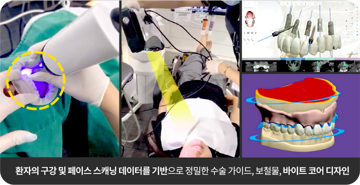 환자의 구강 및 페이스 스캐닝 데이터를 기반으로 정밀한 수술 가이드, 보철물, 바이트 코어 디자인