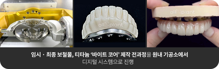 임시 · 최종 보철물, 티타늄 ‘바이트 코어’ 제작 전과정을 원내 기공소에서 디지털 시스템으로 진행