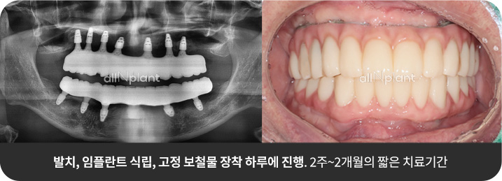 발치, 임플란트 식립, 고정 보철물 장착 하루에 진행. 2주~2개월의 짧은 치료기간
