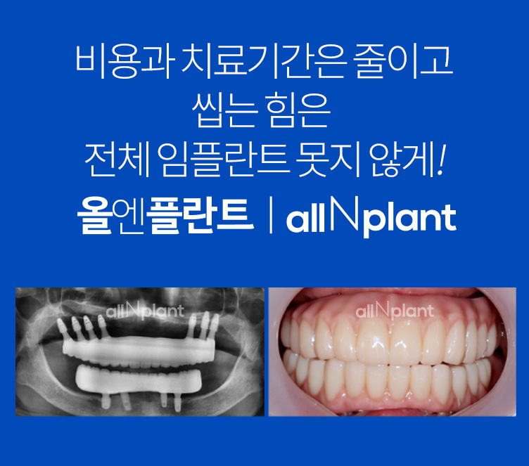 비용과 치료기간은 줄이고 씹는 힘은 전체임플란트 못지 않게!