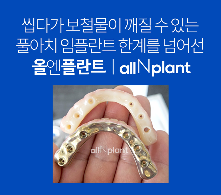씹다가 보철물이 깨질 수 있는 풀아치 임플란트 한계를 넘어선