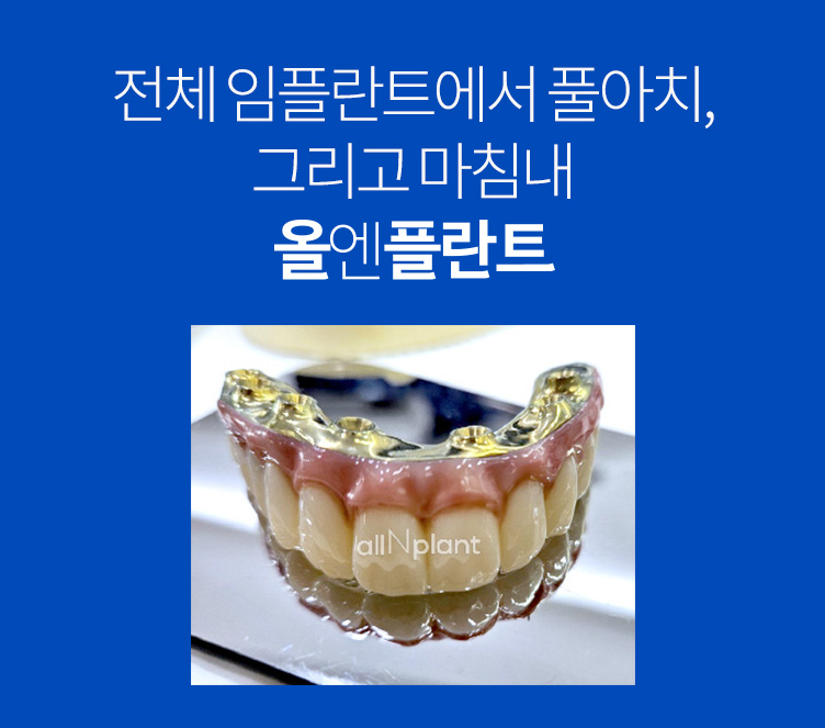 전체 임플란트에서 풀아치, 그리고 마침내 올엔플란트