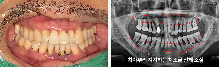 치아뿌리 지지하는 치조골 전체 소실