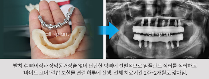 발치 후 뼈이식과 상악동거상술 없이 단단한 턱뼈에 선별적으로 임플란트 식립를 식립하고 ‘바이트 코어’ 결합 보철물 연결 하루에 진행. 전체 치료기간 2주~2개월로 짧아짐.