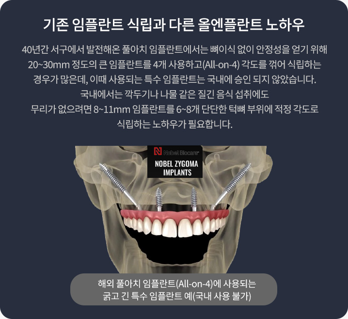 기존 임플란트 식립과 다른 올엔플란트 노하우. 40년간 서구에서 발전해온 풀아치 임플란트에서는 뼈이식 없이 안정성을 얻기 위해 20~30mm 정도의 큰 임플란트를 4개 사용하고(All-on-4) 각도를 꺾어 식립하는 경우가 많은데, 이때 사용되는 특수 임플란트는 국내에 승인 되지 않았습니다. 국내에서는 깍두기나 나물 같은 질긴 음식 섭취에도 무리가 없으려면 8~11mm 임플란트를 6~8개 단단한 턱뼈 부위에 적정 각도로 식립하는 노하우가 필요합니다.