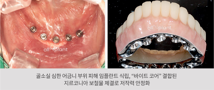 골소실 심한 어금니 부위 피해 임플란트 식립, “바이트 코어” 결합된 지르코니아 보철물 체결로 저작력 안정화