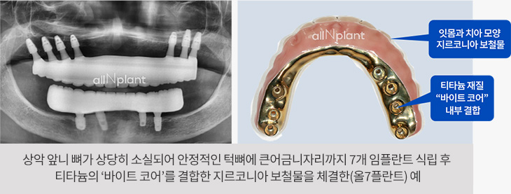 잇몸과 치아 모양 지르코니아 보철물 / 티타늄 재질 “바이트 코어” 내부 결합. 상악 앞니 뼈가 상당히 소실되어 안정적인 턱뼈에 큰어금니자리까지 7개 임플란트 식립 후 티타늄의 ‘바이트 코어’를 결합한 지르코니아 보철물을 체결한(올7플란트) 예