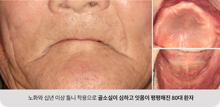 노화와 십년 이상 틀니 착용으로 골소실이 심하고 잇몸이 평평해진 80대 환자