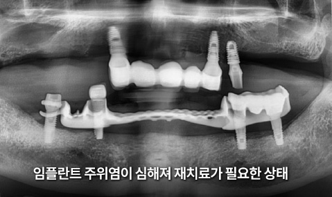 임플란트 주위염이 심해져 재치료가 필요한 상태