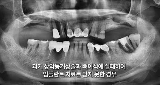과거 상악동거상술과 뼈이식에 실패하여 임플란트 치료를 받지 못한 경우