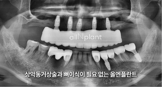상악동거상술과 뼈이식이 필요 없는 올엔플란트