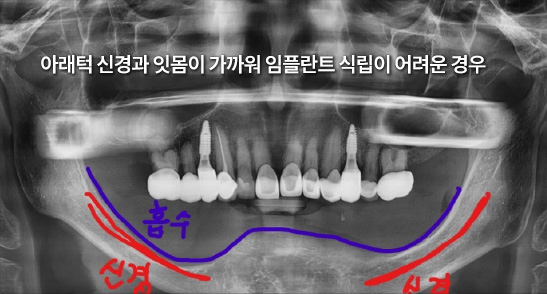 아래턱 신경과 잇몸이 가까워 임플란트 식립이 어려운 경우