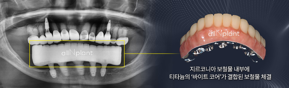지르코니아 보철물 내부에 티타늄의 ‘바이트 코어’가 결합된 보철물 체결